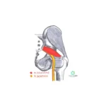 Sdr del piriforme - Perché non riesci a guarire? TrattaMIX